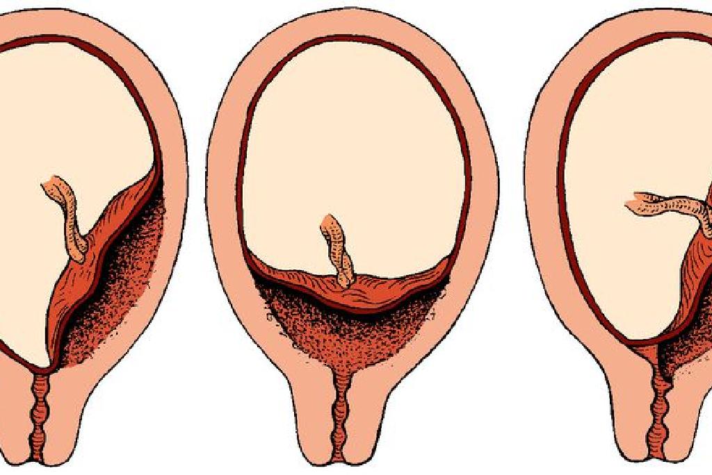 Wat Is Placenta Previa